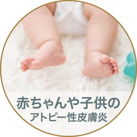 赤ちゃんや子供のアトピー性皮膚炎
